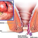 Illustration for article titled Penyakit Wasir Berbahaya Tidakem/em
